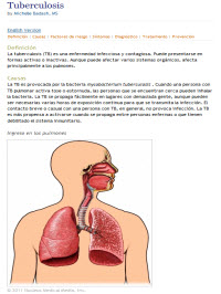 Tuberculosis