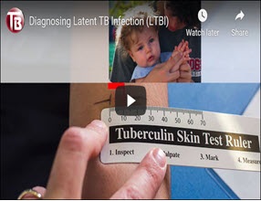 Diagnosing Latent TB Infection (LTBI) video