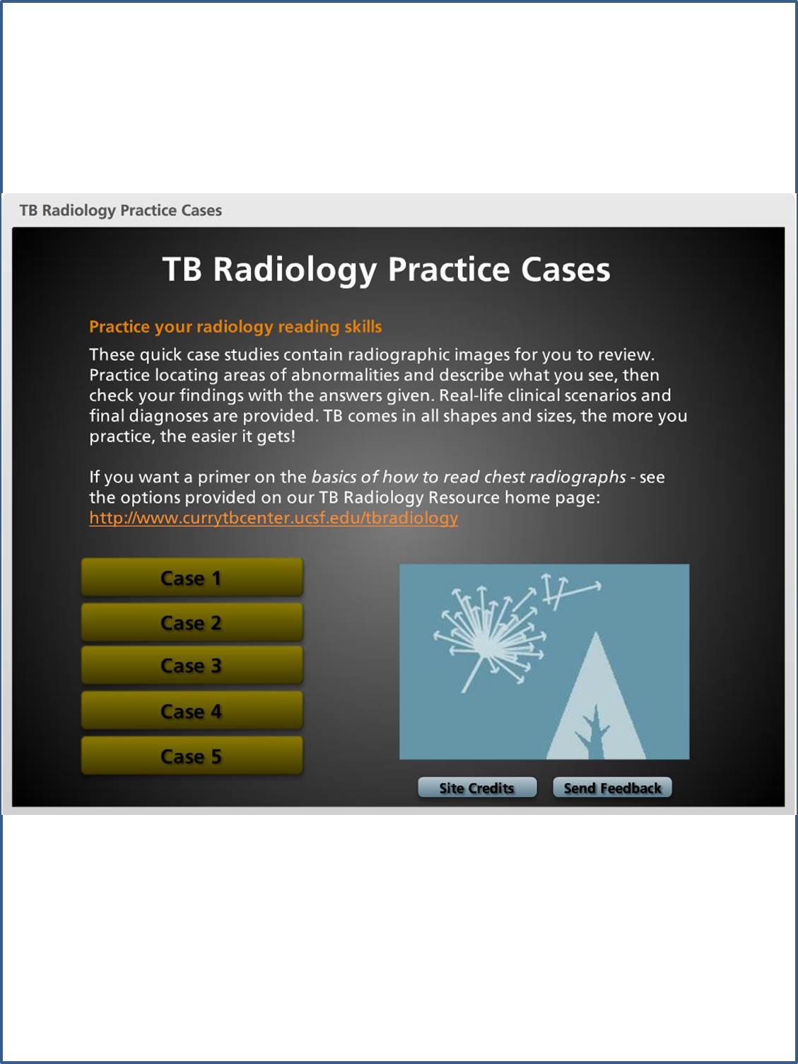 Tuberculosis Radiology Practice Cases