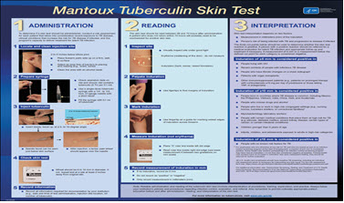 Mig selv kuffert fryser The Mantoux Tuberculin Skin Test Wall Chart | National Prevention  Information Network | Connecting public health professionals with trusted  information and each other