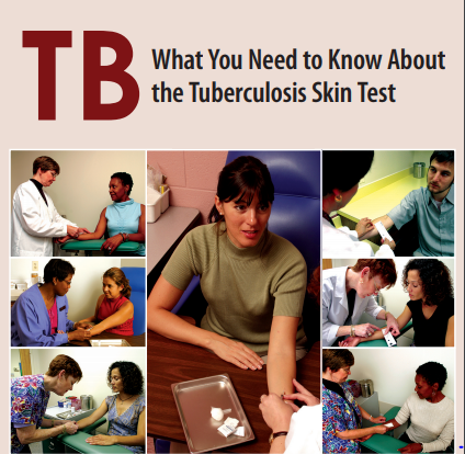 Tbwhat You Need To Know About The Tuberculosis Skin Test