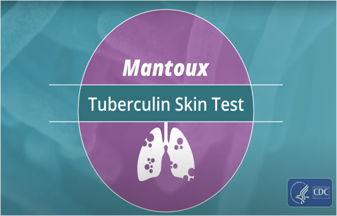 Mantoux Tuberculin Skin Test Video (Web)