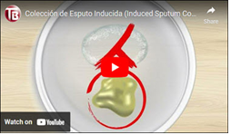 Colección de Esputo Inducida [Induced Sputum Collection]. Go to video