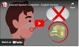 Induced Sputum Collection. Go to video