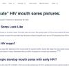 Early or “Acute” HIV Mouth Sores Pictures. (Web)