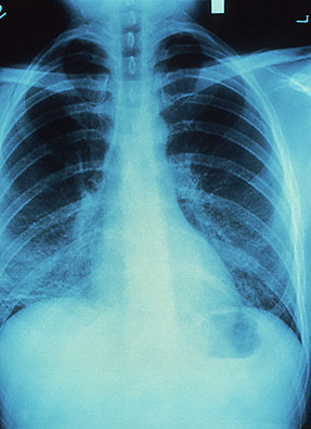 Photo of x-ray of a lung with tuberculosis